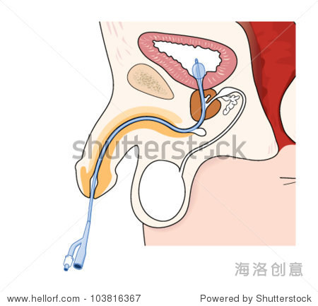 画一根导管的男性,显示导管的位置在尿道和膀