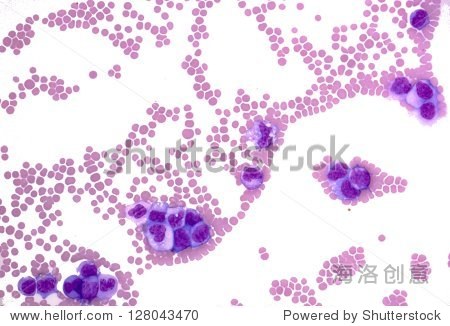 血涂片显示myelomonocytic白血病。涂片显示大
