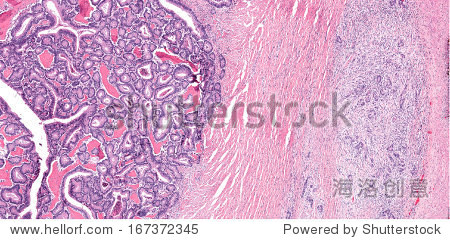 cancer with osseous trabeculae and invasion of intestinal wall