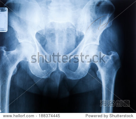 x ray mri - image of spine pain and hip bone