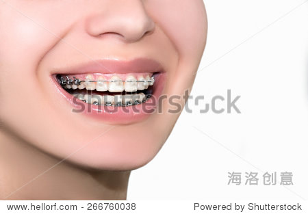 ceramic and metal braces teeth female smile closeup isolated on
