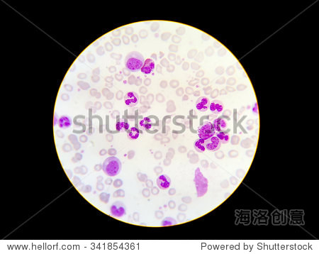 嗜中性粒细胞和胚细胞,显微镜下血涂片 - 医疗