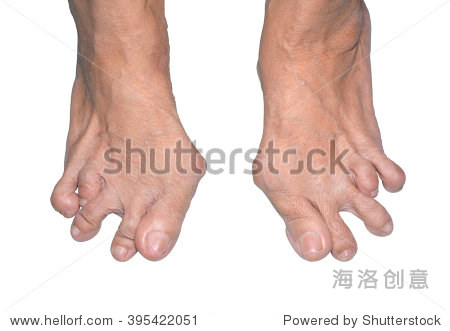 老女人的脚变形类风湿性关节炎孤立在白色背景