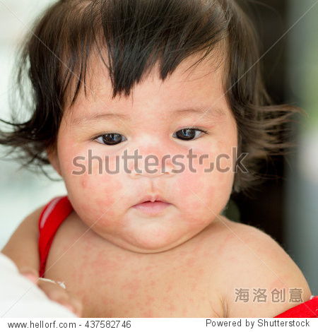 皮疹疹,红疹infantum,第六疾病,seudo风疹宝宝