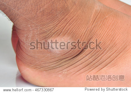 anklebone men s skin pigmentation asians .