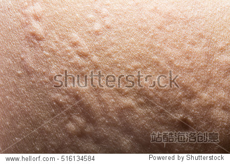 close up of urticaria or allergy rash