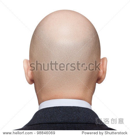 人类脱发或脱发--成年男人秃顶后或视图 - 医疗