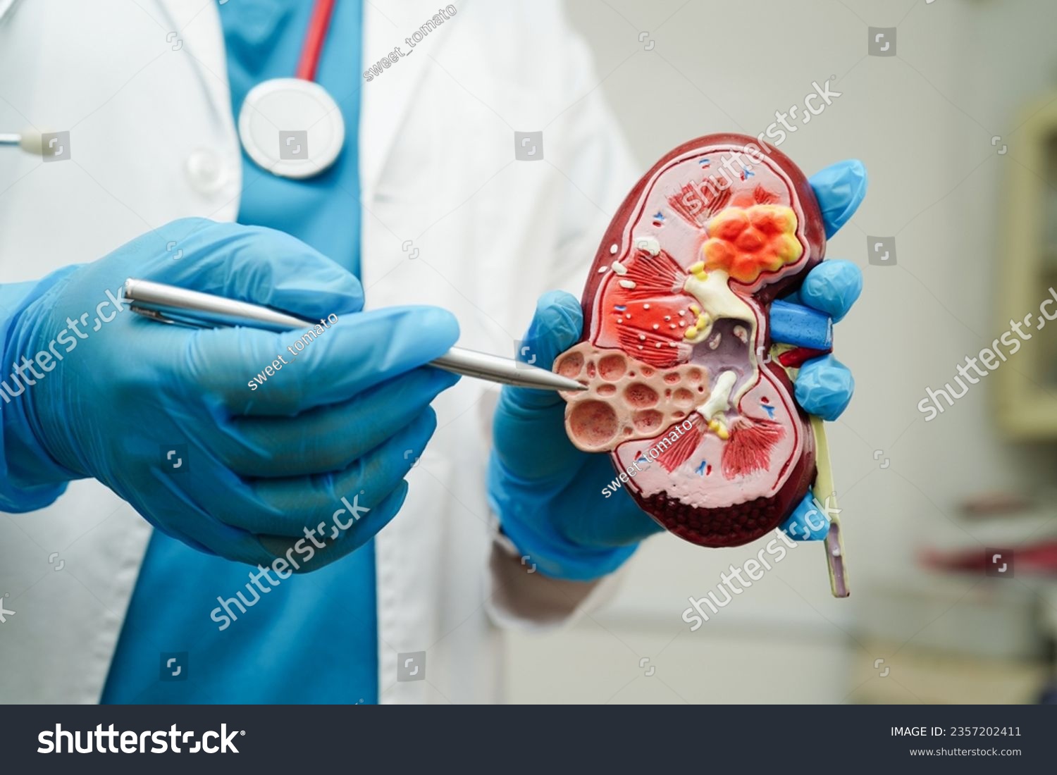 Chronic kidney disease  doctor holding model for treatment urinary system  urology  Estimated glomerular filtration rate eGFR.