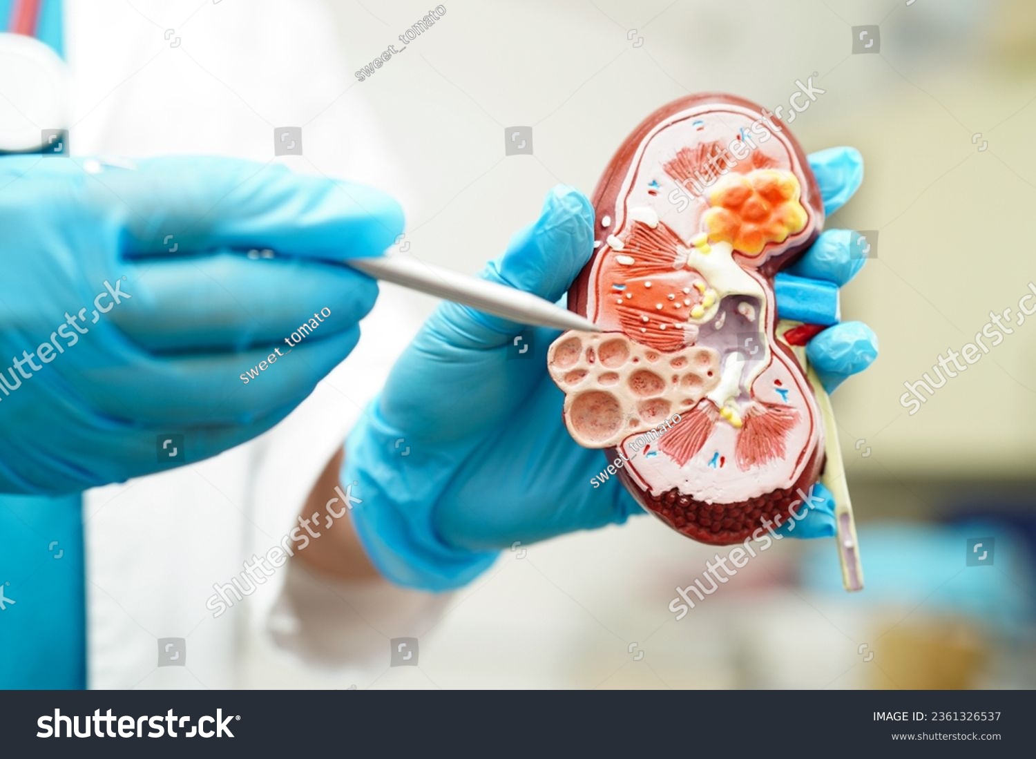 Chronic kidney disease  doctor holding model for treatment urinary system  urology  Estimated glomerular filtration rate eGFR.