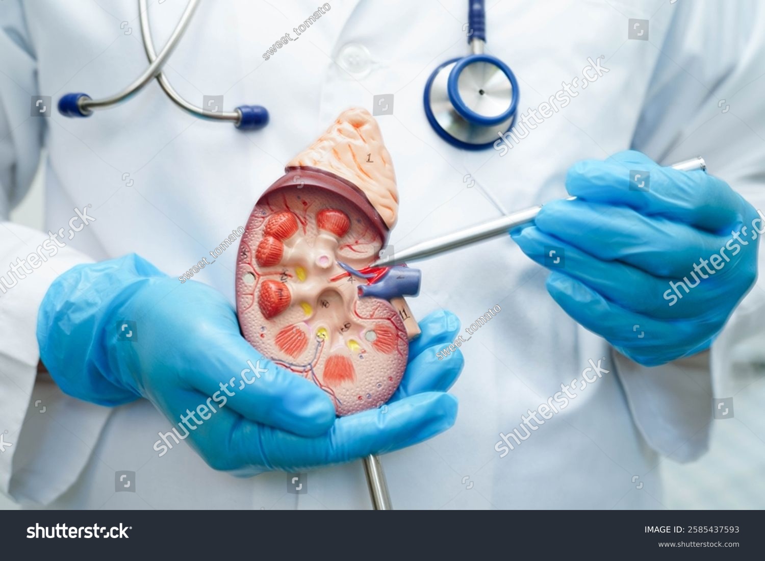 Chronic kidney disease  doctor with model for treatment urinary system  urology  Estimated glomerular filtration rate eGFR.