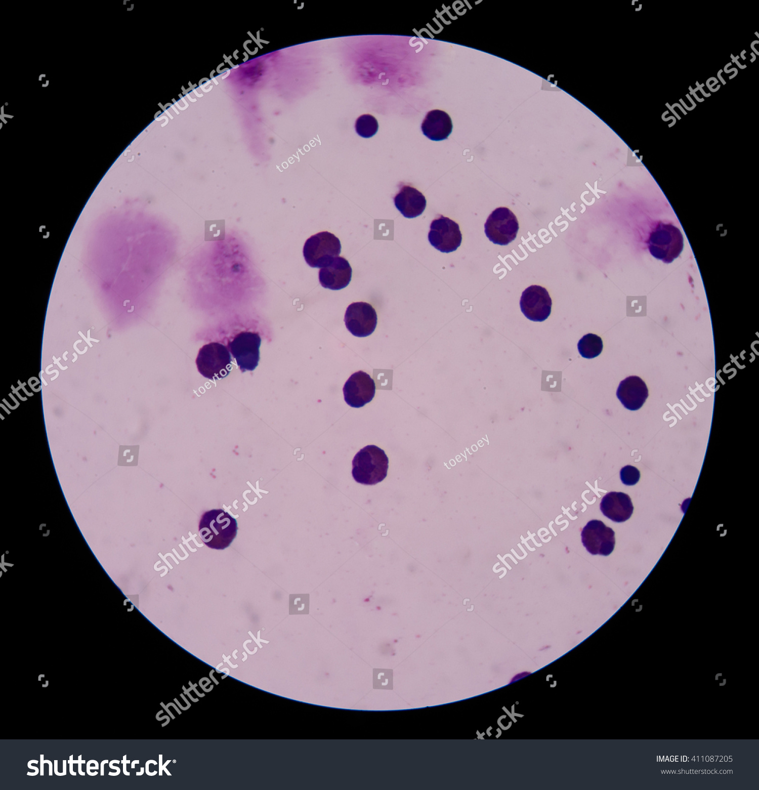 malignant cells with multiple nuclei and prominent nucleoli