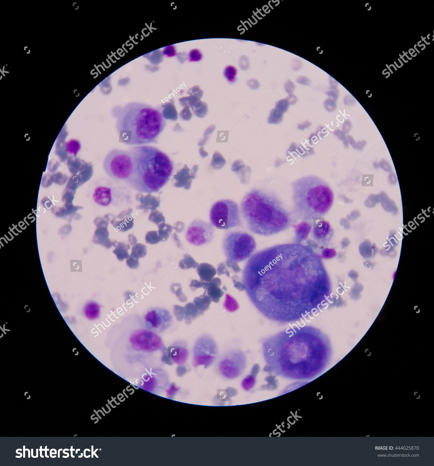 malignant cells with multiple nuclei and prominent nucleoli