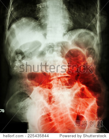 small bowel obstruction.