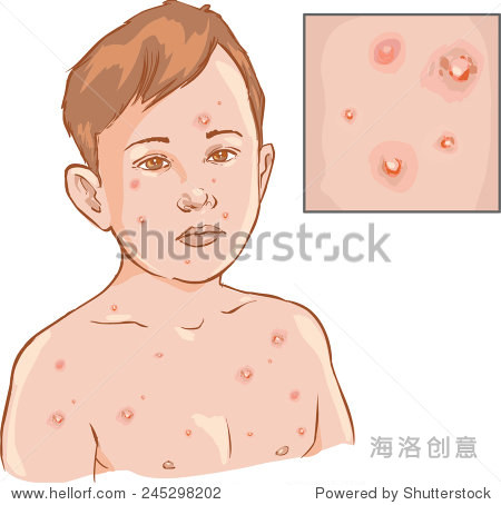 chicken pox