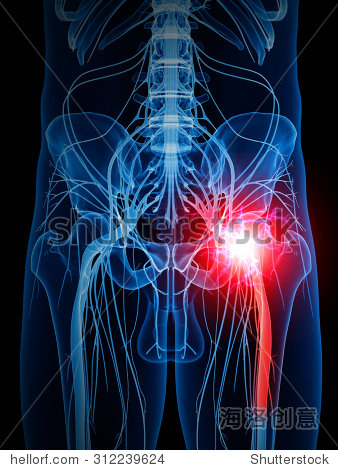 medically accurate illustration of a painful sciatic nerve
