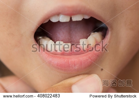 lost milk tooth girl, close up view.
