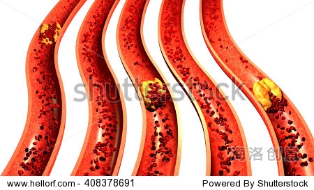 clogged artery with platelets and cholesterol plaque, concept