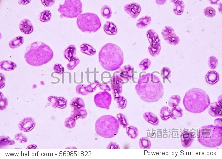 blood smear under microscopy showing on adult acute myeloid