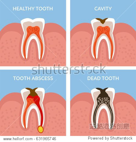 stages of tooth decay. dental anatomy concept.