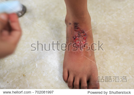 infectious wounds - 图片素材 - 站酷海洛plus正版图