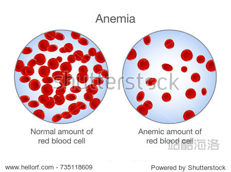 thedifferenceofanemiaamountofredbloodcellandnormalillustration
