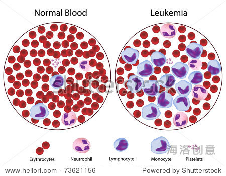 leukemic versus normal blood - 站酷海洛正版图片