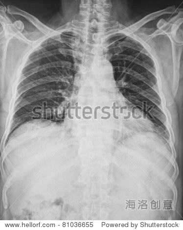 x-ray image of human chest - 图片素材 - 站酷海洛plus正版图片