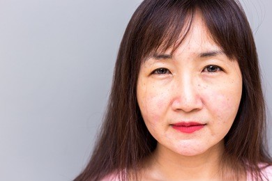 health care concept: closeup face, pretty asian woman is allergic some cosmetics or dust that makes her face allergy, rash and scratchy. beautiful woman looks so sad because of ugly face, copy space