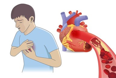 man have chest pain from blood cell can't flow into heart by fatty. illustration about coronary artery disease and medical concept.
