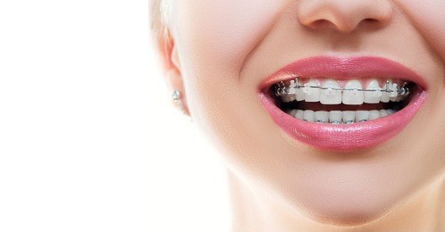 braces smile. orthodontic treatment.