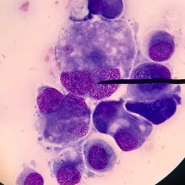 malignant cell. cell from pleural effusion specimen.the biggest and deep blue cytoplasm.