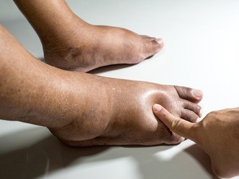 the feet of people with diabetes, dull and swollen.
