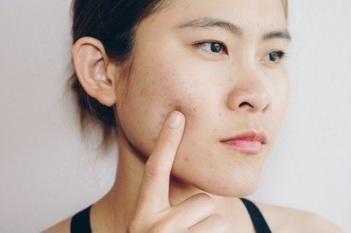 portrait of asian woman has problems with skin on her face. problems with acne and scar on the female skin.