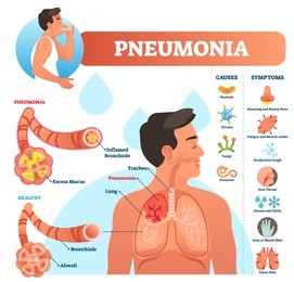 pneumonia vector illustration. labeled diagram with causes and symptoms. medical closeup and isolated lung and respiratory system structure. sneezing and cough reason.