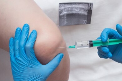 a doctor injects a medical injection of chondroprotector and hyaluronic acid into the knee of a woman to restore the knee joint, cartilage and synovial fluid, close-up
