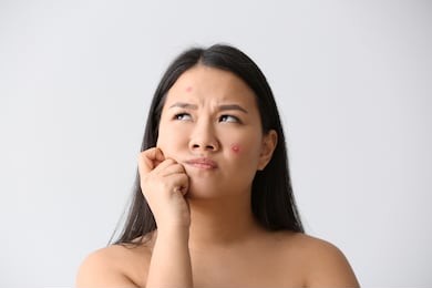 portrait of young asian woman with acne problem on white background
