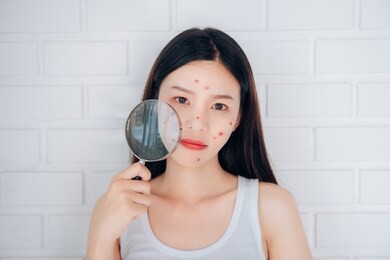 young asian woman holding magnifying glass check acne her face problem.