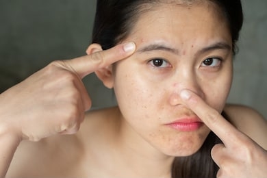 portrait of asian woman pointing acne problem on her face. conceptual of problems on woman skin.
