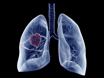 3d rendered medically accurate illustration of a lung tumor