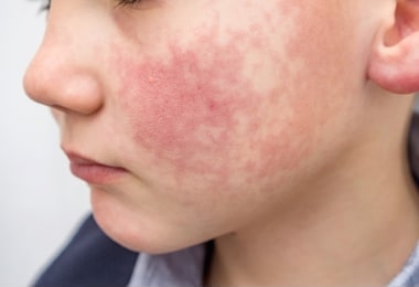 boy with red cheeks- diathesis or allergy symptoms. redness and peeling of the skin on the face. 