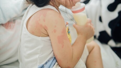 asian girl with rash from milk allergy.