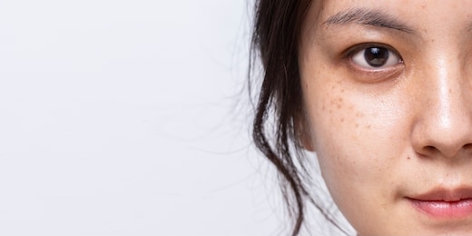 close up half fresh face of asian women is looking at camera on white banner background with copy space, problem skin face, freckle on face of asian women, 