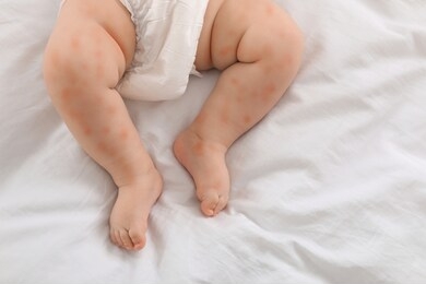 little child with red rash on bed, top view. baby allergies
