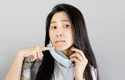 young asian woman wearing medical face mask and white t shirt, her hand point at pimple on chin,skin allergy from wearing a mask