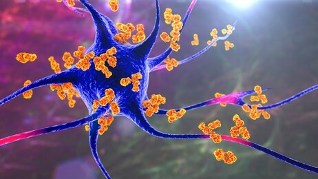 antibodies attacking neuron, 3d illustration. concept of autoimmune neurologic diseases