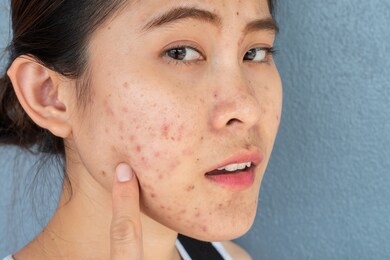 portrait of ugly asian woman having problems of acne inflammation (papule and pustule) on her face. conceptual of problems on woman skin.