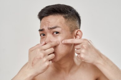 close up portrait of shirtless young asian man with problematic skin checking his skin, squeezing pimple isolated over white background. beauty, skincare concept. horizontal shot