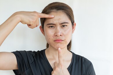asian woman pointing the problems of acne inflamed on her face. inflamed acne consists of swelling, redness, and pores that are deeply clogged with bacteria, oil, and dead skin cells.