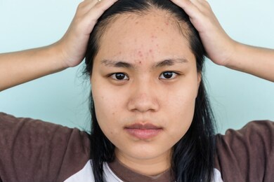 close up of young asian woman worry about her face when she has problems with skin on her face.  problems with acne and scar on the female skin. problem skincare and health concept.