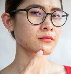 headshot of asian woman pointing to acne occur on her face. inflamed acne consists of swelling, redness, and pores that are deeply clogged with bacteria, oil, and dead skin cells.
